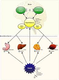 Image result for Cachexia in Cancer