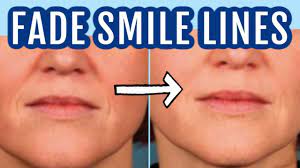 Botulinum toxin (aka botox) is injected in small amounts around the mouth to. 12 Ways To Fade Smile Lines Nasolabial Folds Dr Dray Youtube