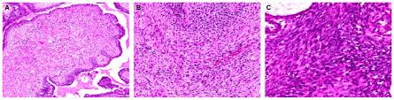 malignant phyllodes tumors can spread beyond the breast, although this happens less often than with more common types of breast cancer. Phyllodes Tumours Of The Breast A Consensus Review Abstract Europe Pmc