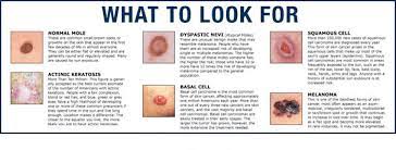 This is called the stage. Skin Cancer Sunscreen Self Check Contour Dermatology