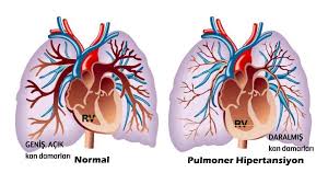 Hazırladığımız bu videoda vücudumuzdan nabız alınan arterlerin(atardamar) isimlerini yerlerini ve yetişkin,çocuk,bebek nabız sayısını uygulamalı şekilde anlatıcaz iyi seyirler. Pah Nasil Teshis Edilir