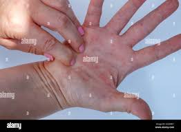 Dermatitis Atopica Manos Rojas Problema Dermatologico Manos Femeninas Alergia Y Picazon Concepto Minimo Fondo Blanco Fotografia De Stock Alamy