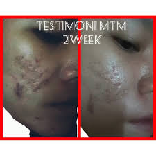 Ikuti cara bagaimana menghilangkan parut jerawat hitam anda dengan mudah disini. Ready Stock Magic Tamarind Mask Membantu Menghilangkan Jerawat Jeragat Parut Berlubang Whitehead Blackhead Shopee Malaysia
