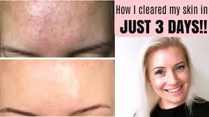 This site contains affiliate links from which we receive a compensation (like amazon for example). Getting Rid Of Tiny Bumps Malessezia Foliculitis Fungal Acne Fickle Beauty