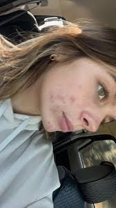 How to get rid of acne?