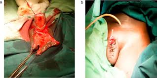 Résultat de recherche d'images pour "penis degloved"