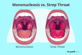 Image result for Strep throat infection roof of mouth