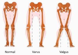 Douleur Au Genou Les 5 Causes De Douleurs Selon L Osteopathe