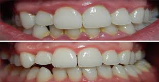 Can you remove tartar at home? Remove Tartar And Build Up In Your Mouth With These Simple Easy Tips