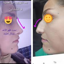 اصلاح تشوه الانف السرجي لانف معمول سابقا عند احد الزملاء سبب هذا التشوه  النحت الذائد لظهر الانف العلاج بطعم من نفس الجسم تواصل واتس حصريا مندوبي  بالعراق حصريا ابو مصطفى الموالي ٠٠٩٦٤٧٧٠٧١٧٨٦٥١