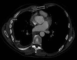 ct useful to differentiate lung nodules from pleural plaques, round atelectasis, and lung fibrosis. Volumetry An Alternative To Assess Therapy Response For Malignant Pleural Mesothelioma European Respiratory Society