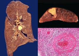 Sep 17, 2020 · necrosis is caused by a lack of blood and oxygen to the tissue. The Different Types Of Necrosis And Their Histological Identifications Andreas Astier