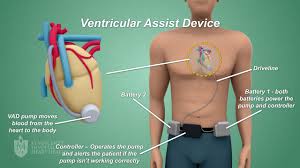 While you're in the hospital, you may have other treatments for your weakened heart or heart failure. Ventricular Assists Devices Vads St Vincent S Heart Health