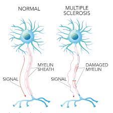 The multiple sclerosis collaborative research group. Multiple Sclerosis Symptoms And Causes Neurology Beaumont Health