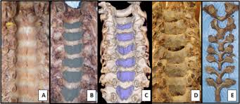 Each ligamentum flavum connects two adjacent vertebrae, beginning with the junction of the axis and third cervical vertebra, continuing down to the junction of the fifth lumbar vertebra and the sacrum. Anatomical Analysis Of Human Ligamentum Flavum In The Cervical Spine Special Consideration To The Attachments Coverage And Lateral Extent Journal Of Orthopaedic Science