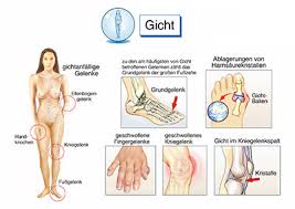 Gicht Ursachen Symptome Behandlung Medlexi De