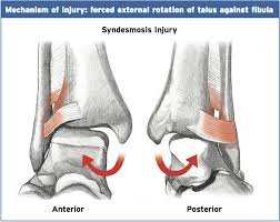 Image result for Ankle External Rotation Test