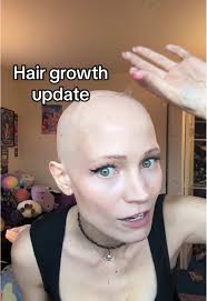 Abby Alopecia