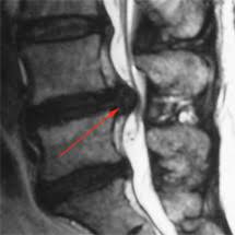 Prof Dr Christian Woiciechowsky Neurochirurgie Berlin Lendenwirbelsaule