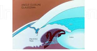 Reviewed by gary heiting, od. Figure 2 From Chapter 15 Primary Angle Closure Glaucoma Semantic Scholar