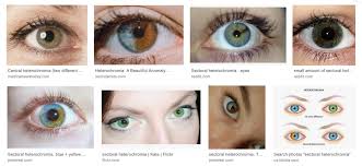 It often happens in both eyes, with two separate colors appearing in each eye. It S 5 O Clock Somewhere Heterochromia Iridum 1 In Complete