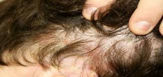 افضل طريقة لعلاج سعفة الرأس عند الاطفال Behind Ear Tattoo Ear Tattoo Ear