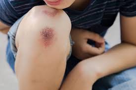 Cara menghilangkan bekas luka di kaki secara alami pertama yaitu dengan vitamin e. 4 Cara Menghilangkan Bekas Luka Bisa Pakai Bawang Merah Halaman All Kompas Com