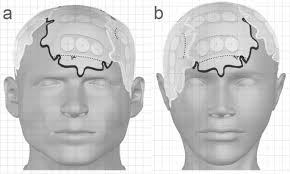 Preliminary study of feasibility of surface-guided radiotherapy with  concurrent tumor treating fields for glioblastoma: region of interest