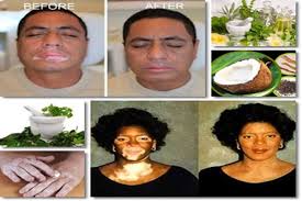 Natural Vitiligo Treatment System Review How To Banish Vitiligo With Natural Vitiligo Treatment System Hynguyenblog Com