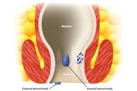 We did not find results for: Hemorrhoids Causes Symptoms Diagnosis And Treatment