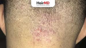 Image result for folliculitis symptoms