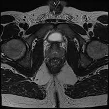 Body weight, physical activity, and diet. Detecting Prostate Cancer Early On And Improving Chances Of Recovery