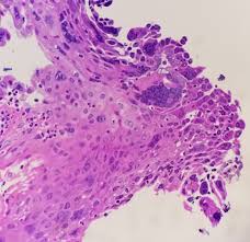 Herpes esophagitis is a viral infection of the esophagus caused by herpes simplex virus (hsv). Abdullah Alswied On Twitter Beautiful Example Of Herpes Esophagitis Pathology Gipath Pathresidents