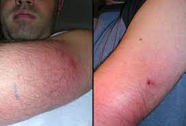 However, some stings can be painful. Spider Bites Black Widow Vs Brown Recluse First Aid