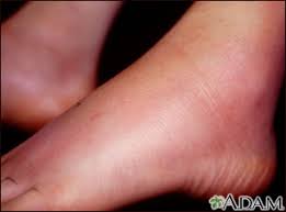 Image result for erythema nodosum