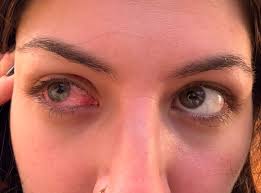 Image result for Keratitis