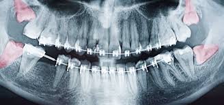 We did not find results for: When Do Wisdom Teeth Come In Fully Grow In
