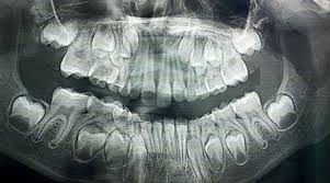 • 12 016 просмотров 4 года назад. X Rays Of Kids Skulls As Their Baby Teeth Get Pushed Out And Their Permanent Teeth Grow In Dangerous Minds