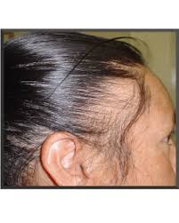 It's described as a reversible condition where hair falls out after a stressful experience. the hair loss usually starts a couple of months after the triggering experience, and doesn't lead to either total baldness or permanent hair loss. Traumatic Alopecia Uk Hair Consultants
