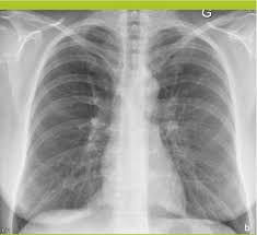 Avec hyperclarté du lobe supérieur droit se majorant. La Pneumonie Organisee Cryptogenique Revue Medicale Suisse