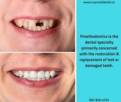 Pin By Jussara On Dental Dental Implants Dental Cosmetic Dentistry