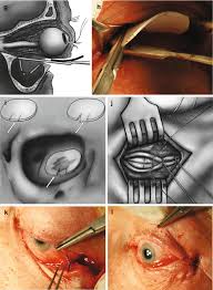 Several different types of body modifications are present throughout neuromancer in one way or another. Orbital Floor Fractures Springerlink