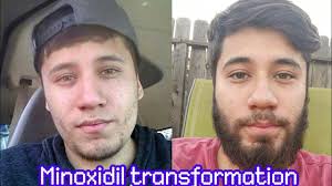 A good way to get used to minoxidil is to start out with 0.5ml and work your. Minoxidil Beard Transformation Officially 2 Years Youtube