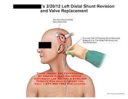 Amicus Illustration Of Amicus Surgery Head Abdomen Shunt Revision Valve Replacement Abdominal Torn Disconnected Peritoneum