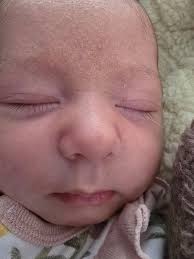 Image result for Cradle Cap