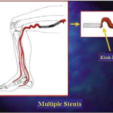 I just don't want it to be fried when i go to develope the pictures. As Stents Are Placed Into The Artery Its Ability To Bend And Compress Download Scientific Diagram
