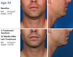 You experience weak muscles in the treated area of in your face. Kybella Vs Double Chin Injections Richmond Va Travis Shaw Md
