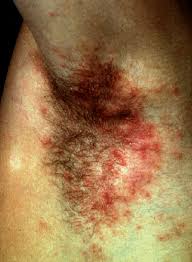 Image result for scabies in the groin area