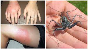 Allergic Reaction To An Insect Bite Code According To Icd 10