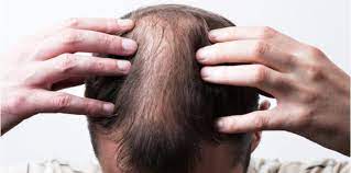 Punca masalah rambut gugur ada juga berkaitan dengan masalah dalaman kita yang kurang baik, contoh biasanya bila kita menghadapi masalah buah pinggang boleh juga menyebabkan rambut kita gugur, ada yang semakin teruk, dan juga masalah penyakit yang lain. Punca Rambut Gugur Di Usia Remaja
